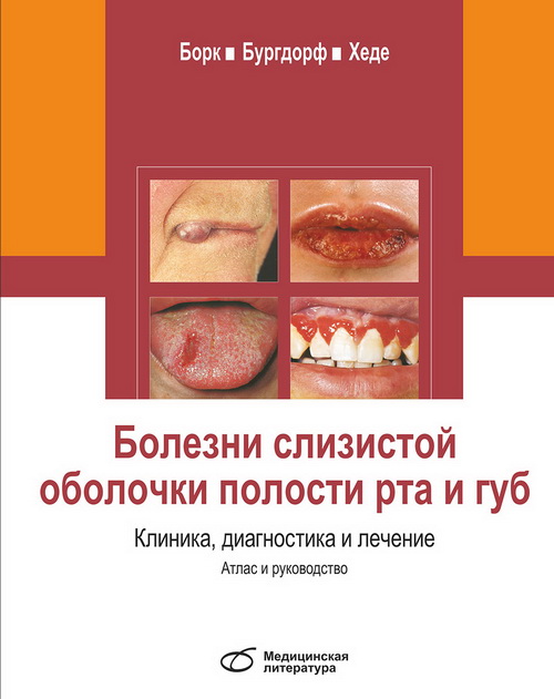 Болезни слизистой оболочки полости рта и губ. Клиника, диагностика и лечение