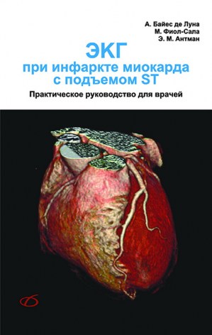 ЭКГ при инфаркте миокарда с подъемом ST